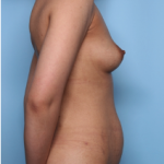 Mommy Makeover Before & After Patient #34324